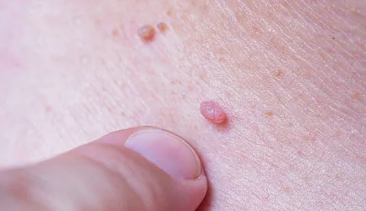 ویروس زگیل از باشگاه ورزشی منتقل می&zwnj;شود؟