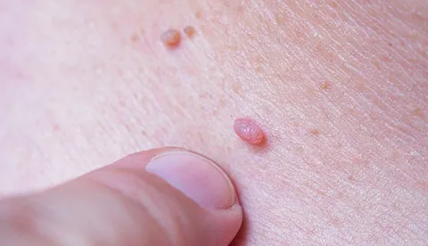 ویروس زگیل از باشگاه ورزشی منتقل می‌شود؟